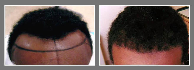 African American male before and after hair transplant results