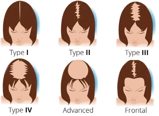 FUE Hair Transplant - Ludwig Female Hair Loss Chart