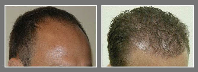 male fut hair transplant