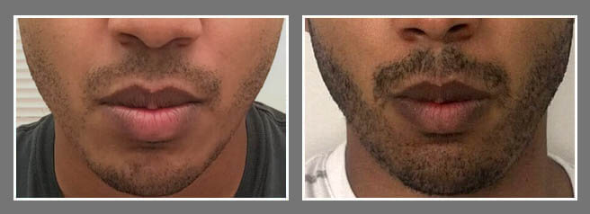 male facial hair transplant beore and after