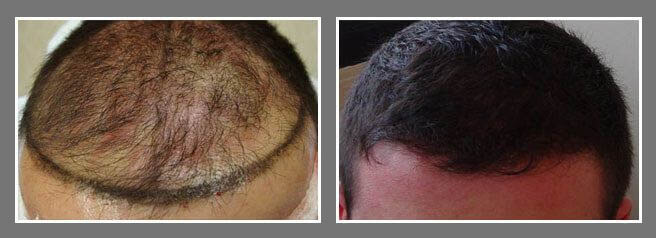 male fue hair transplant before and after